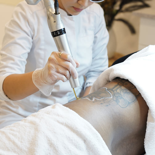 Tattoo weglaseren