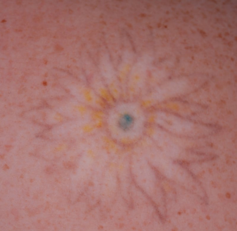 Tattoo weglaseren Tattoo weglaseren