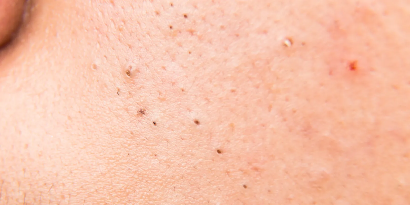 Het weg laseren van een tatoeage